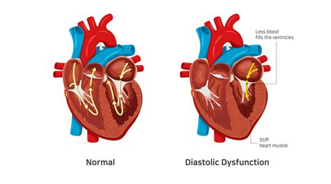 Left Ventricular Diastolic Dysfunction: Causes and .